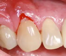 Can Probiotics Prevent Gum Disease?