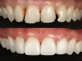 Composite Bonding