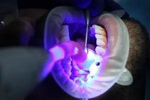 Dental Cleaning Scale & Polish