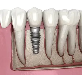 Dental Implant