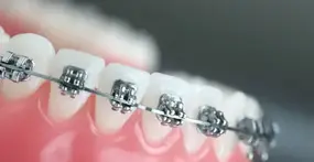 Fixed Braces Fixed Braces