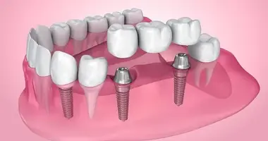 Fixed Bridges and crowns