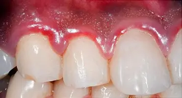 Preventing Gum Disease and Its Complications