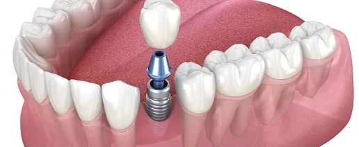 Singular Implants