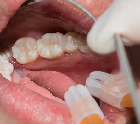 Tooth coloured Composite fillings on Lower Molars