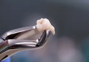 Why not extract the tooth